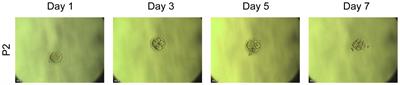 Novel bi-allelic DNAH3 variants cause oligoasthenoteratozoospermia